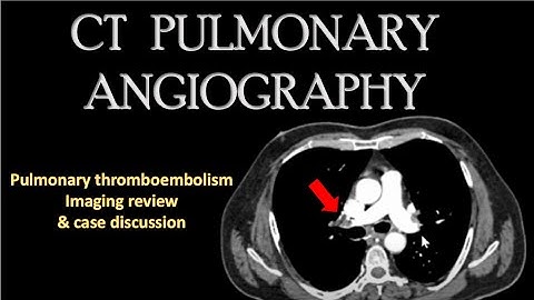 CT PULMONARY ANGIOGRAPHY |PULMONARY THROMBOEMBOLISM| Pulmonary vessels anatomyl Triple rule out CTI