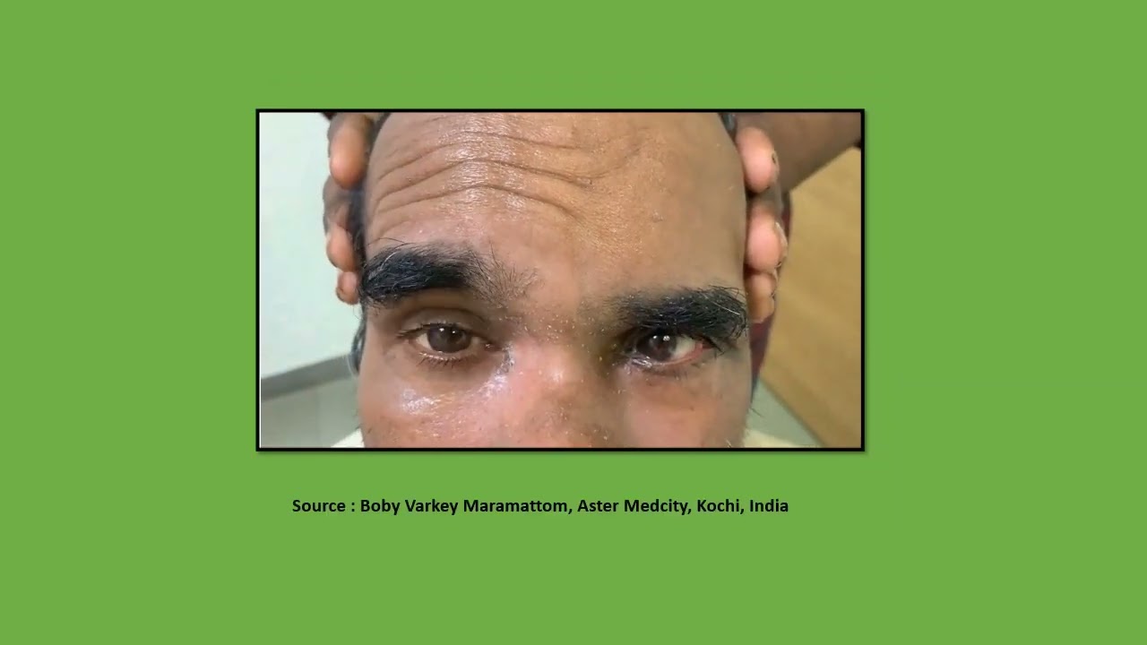 Neurology Quiz #83  CNS Whipple disease