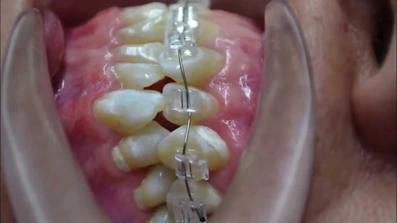 TD Orthodontics / Bracket Autoligado Zafiro SL Dúo YouTube