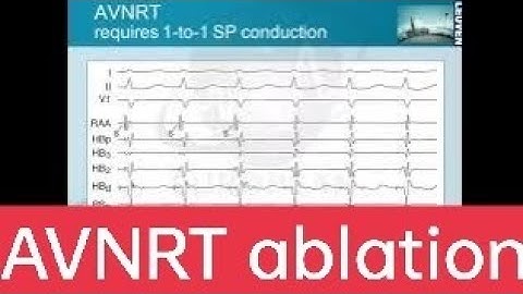 #AVNRT ablation  #avnodalreentrytachycardia #EPstudy #bestcardiology