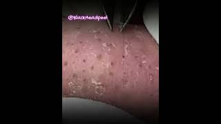 Relax Blackhead Removal 044  shorts  blackhead  acne  pimplesremoval  satisfying