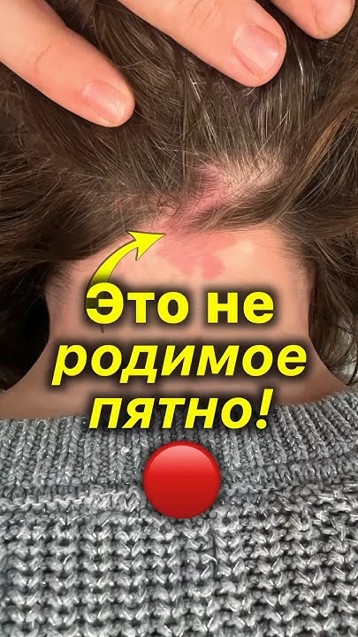Родимое Пятно? 🔴 Нет! - YouTube