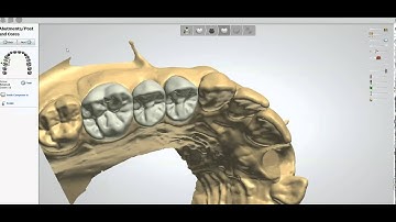 Argen Z Esthetic HT Zi Full Contour Screw Retained Bridge