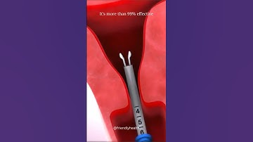 Mirena IUD for Endometriosis | Mirena IUD Experience #familyplanning #contraception #miren