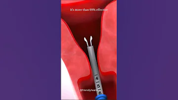 Mirena IUD For Endometriosis Mirena IUD Experience Familyplanning Contraception Miren 