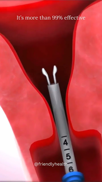 Mirena IUD for Endometriosis | Mirena IUD Experience #familyplanning #contraception #miren