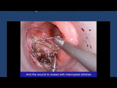 Transanal Minimally Invasive Surgery (TAMIS) For Excision Of Rectal Carcinoid