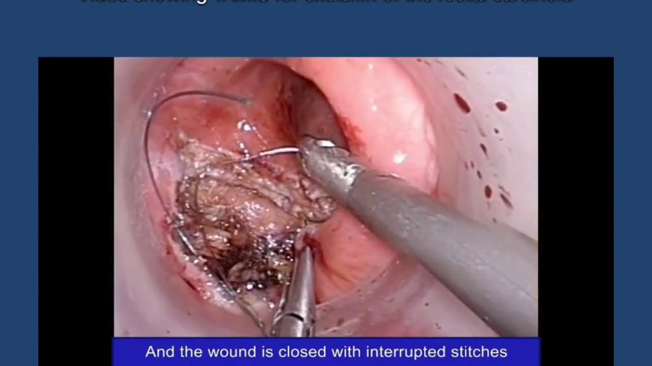 Transanal Minimally invasive surgery (TAMIS) for Excision of Rectal