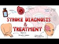 Stroke Diagnosis and Treatment - Acute and Long Term Treatment of Ischemic and Hemorrhagic Stroke