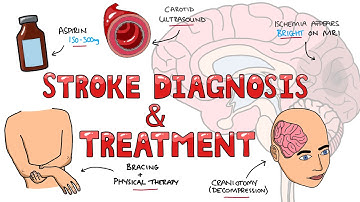 Stroke Diagnosis and Treatment - Acute and Long Term Treatment of Ischemic and Hemorrhagic Stroke