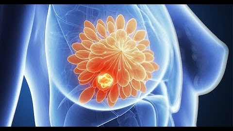 Automatic Detection of Breast Cancer Based on Raman Spectroscopy Using a Neuro Fuzzy Approach