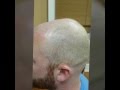 Scalp micropigmentation. Lehigh Valley/Bucks County/ Philadelphia