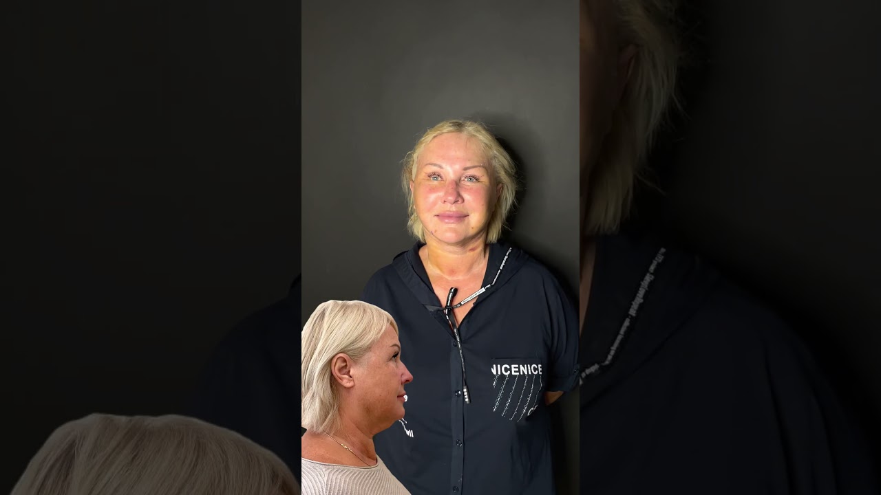 SMAS лифтинг! Как выглядит пациентка в 70 лет, через неделю после подтяжки лица?