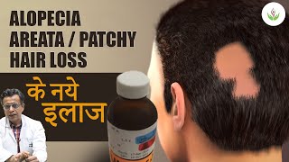 Alopecia Areata Treatment (Patchy Hair Loss) in 2024 | गंजेपन का इलाज | Care Well Medical Centre