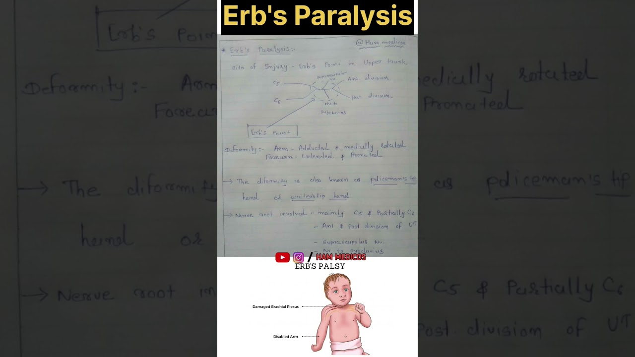 Erb's Paralysis | Erb's Palsy | Policeman's tip hand | 