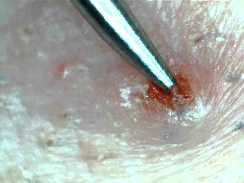 8. How to remove ingrown hair - wide 8