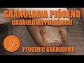 Ingrown toenail with pyogenic granuloma - Granuloma piógeno [Podología Integral] #podologiaintegral