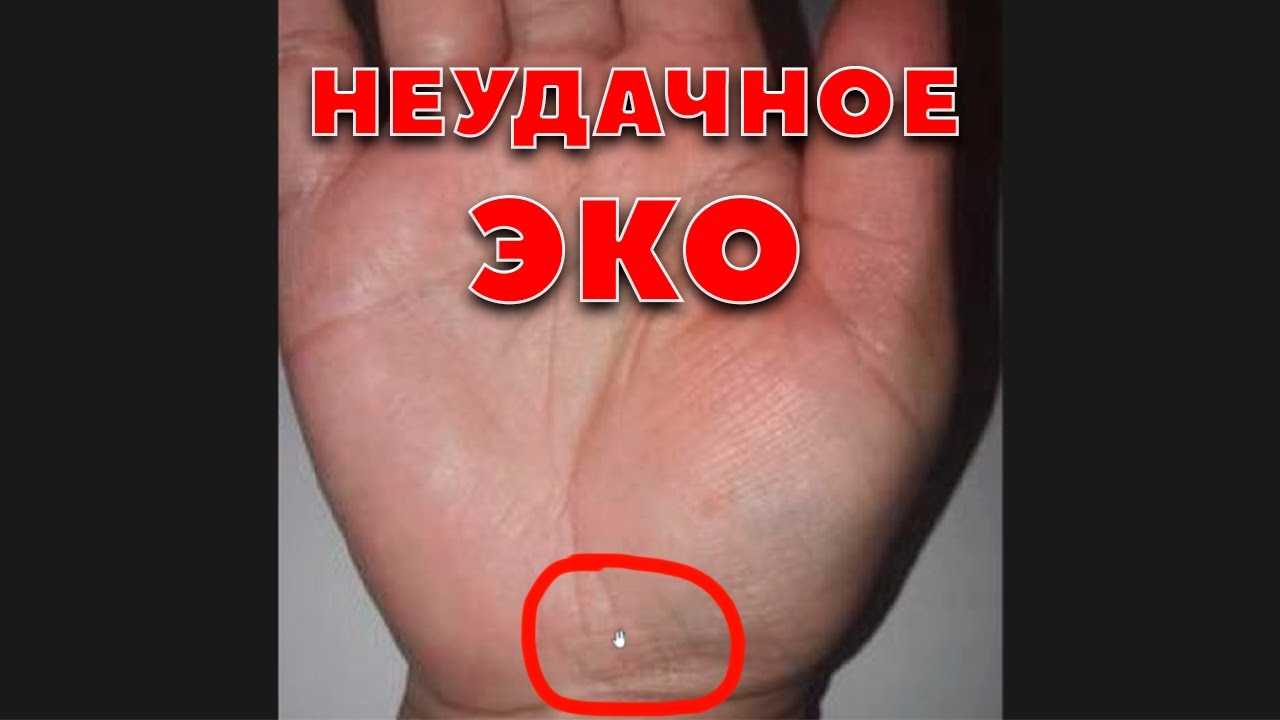 Неудачное ЭКО. Линии на ладонях. Хиромантия - YouTube