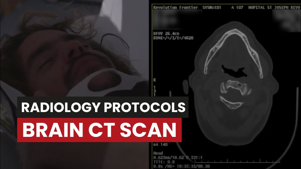 CT Scan of the Brain Without Contrast: A Protocol Guide for CT Techs, image size:1280x720