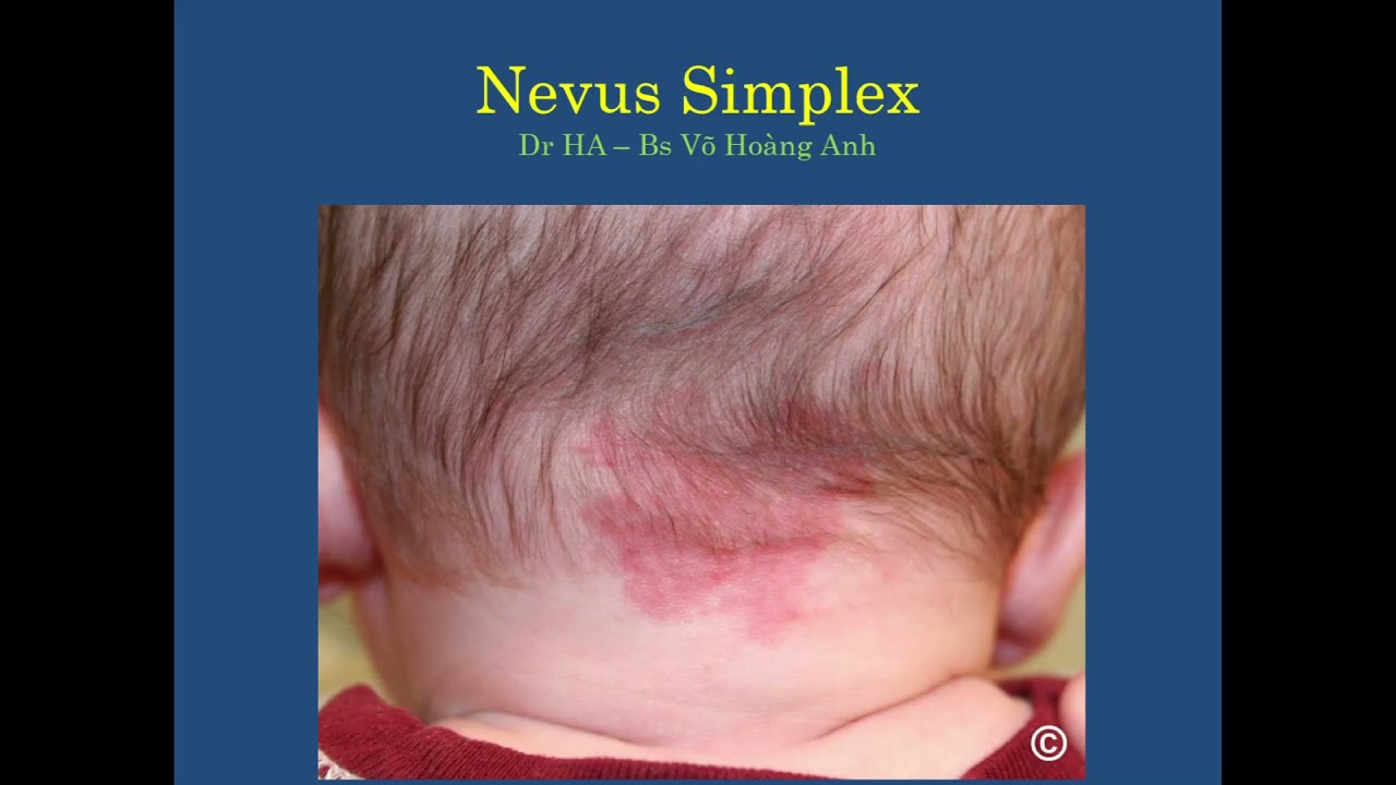 (Dr HA) Nevus Simplex - Điều trị Bớt Cá Hồi / Bs Võ Hoàng Anh