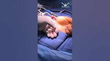 Scaphoid non-union live surgery recap with Dr. Badia
