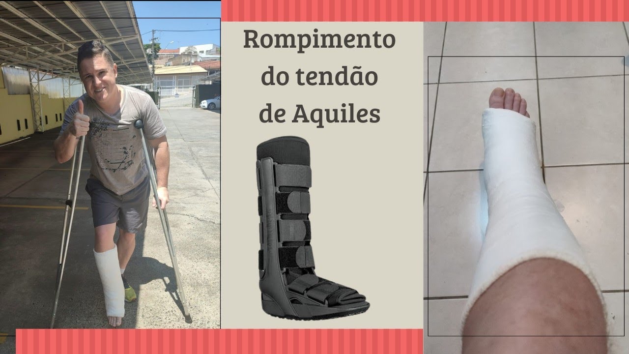 20 dias após a cirurgia do rompimento total do tendão de aquiles.