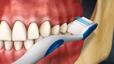 Modified Bass Brushing Technique - Brace Dental Clinics