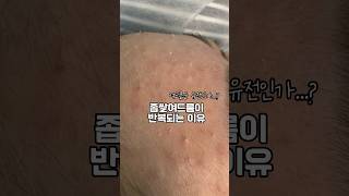 좁쌀여드름이 반복되는 이유