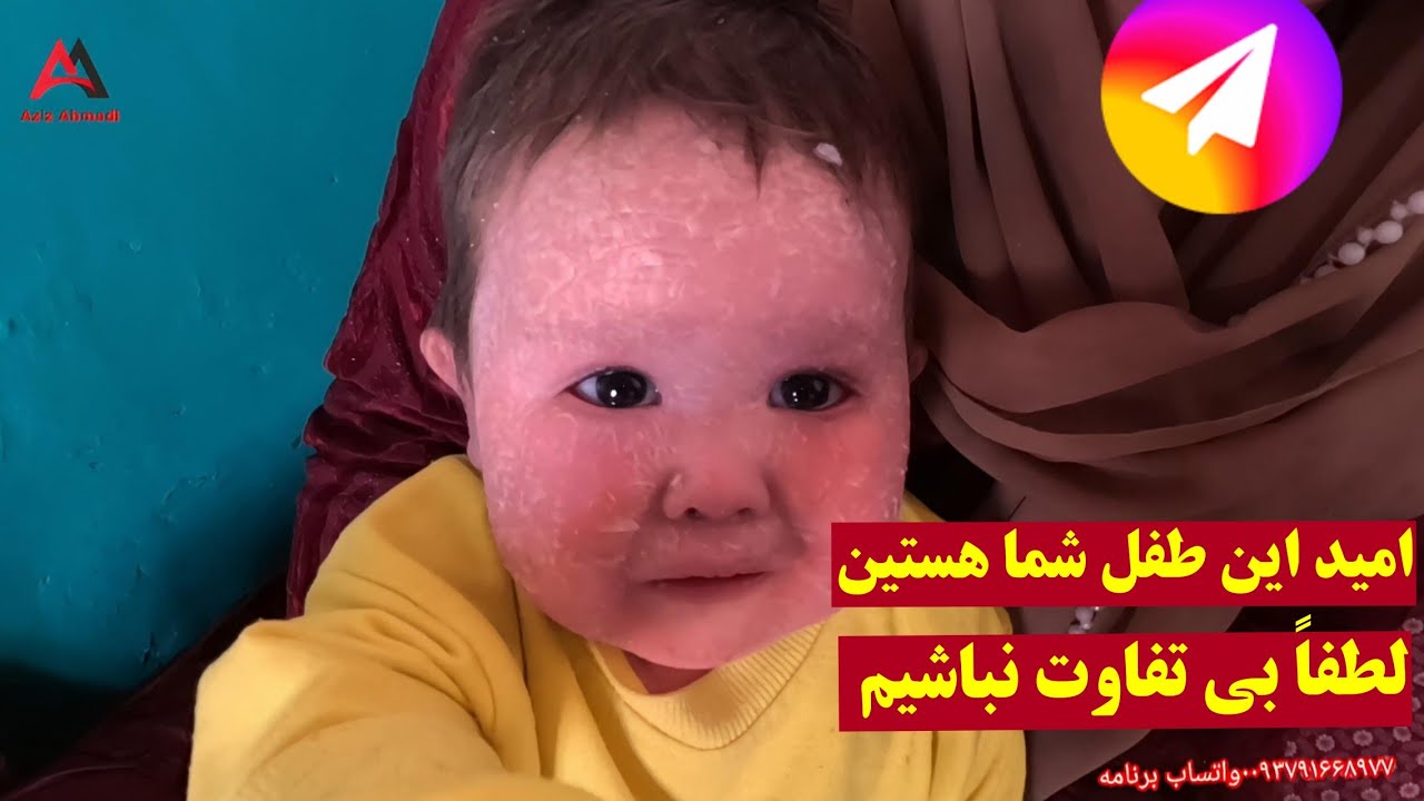 فریاد خاموش یک طفل دوساله ،امیدش فقط دستان مهربان شماست