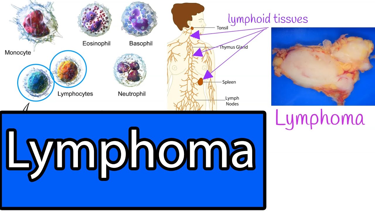 Lymphoma Types Most Common Lymphomas Symptoms And Treatment Youtube