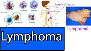 Lymphoma - Types, Most common Lymphomas, Symptoms and treatment