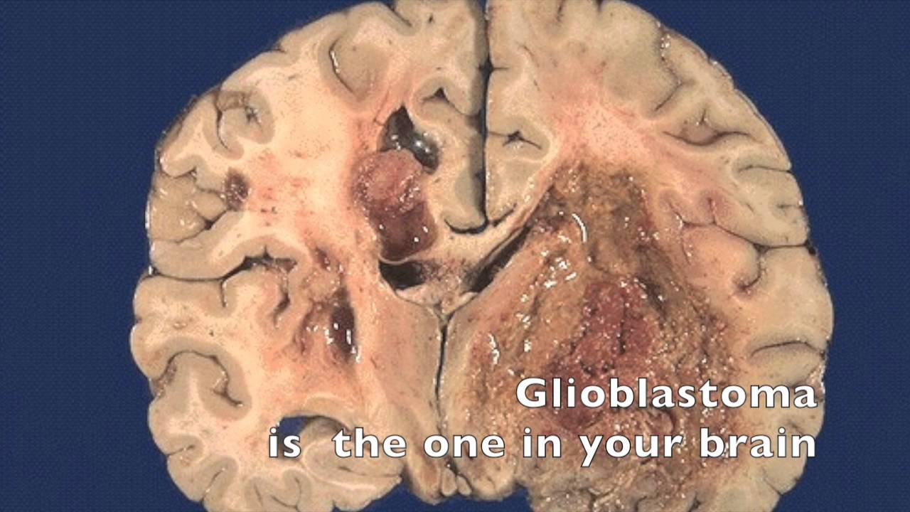 astrocytoma song youtube