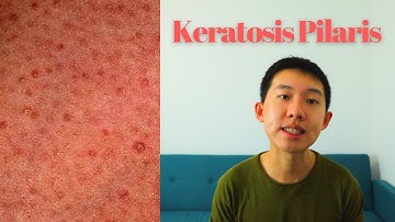 MANAGEMENT OF KERATOSIS PILARIS