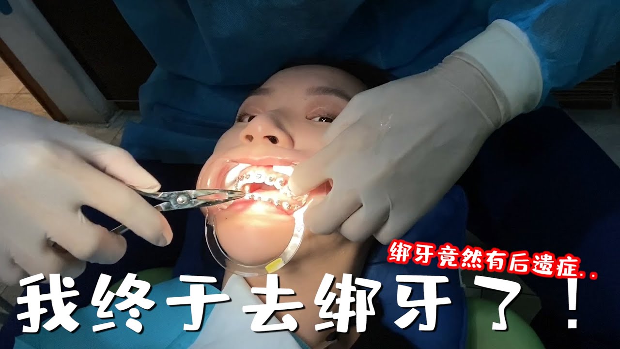 我终于去绑牙了!!! 绑牙竟然有后遗症...