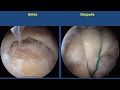Ciruga de manguito rotador por artroscopia