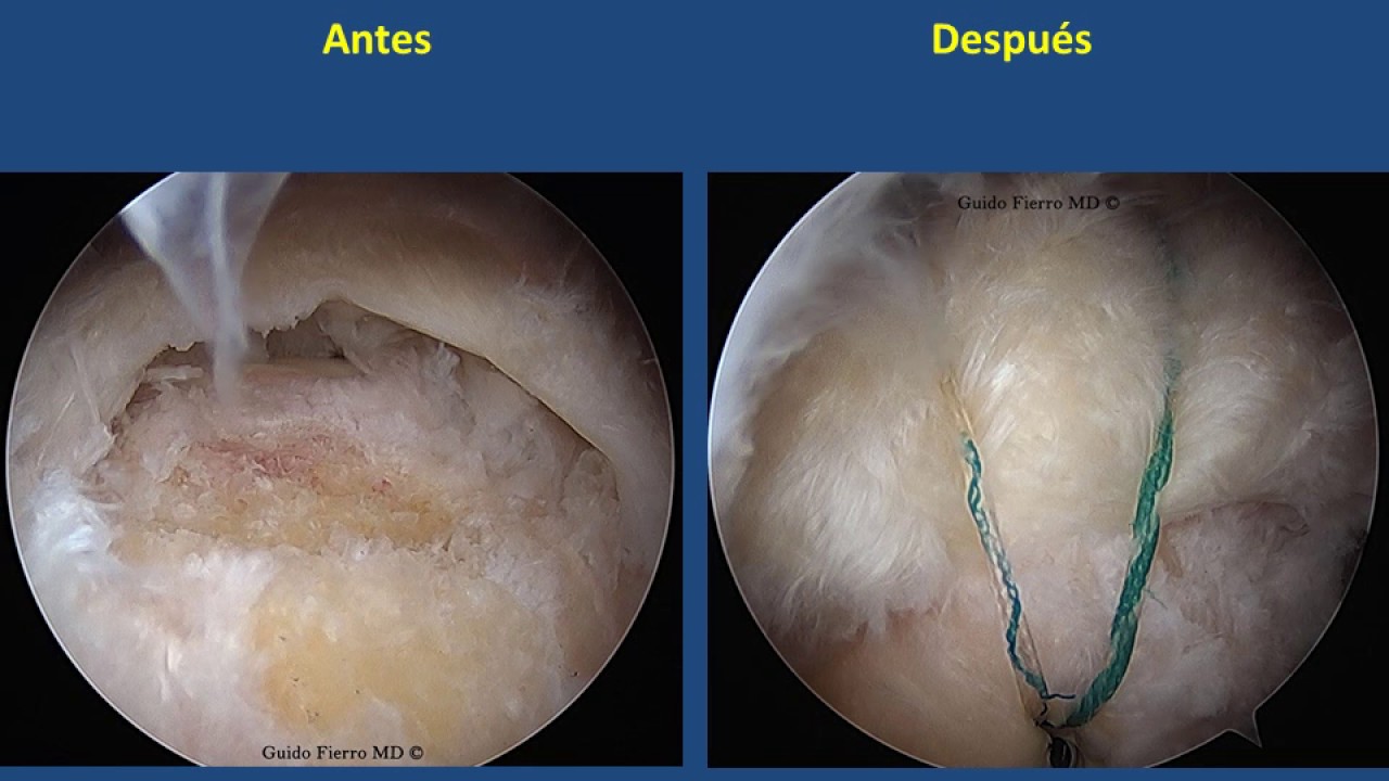 Cirugia De Manguito Rotador Por Artroscopia Youtube