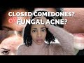 Fungal Acne(Malassezia) or Closed comedones? Here's the difference.