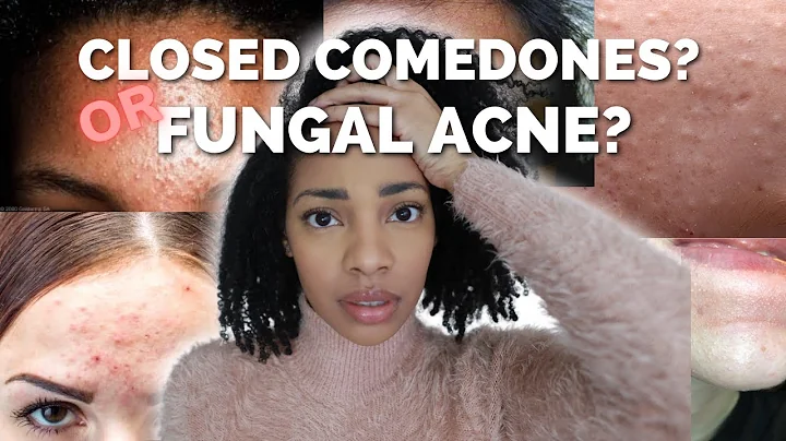 Fungal Acne(Malassezia) or Closed comedones? Here's the difference. - DayDayNews