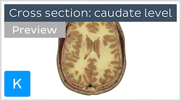 What disease is caudate nucleus?