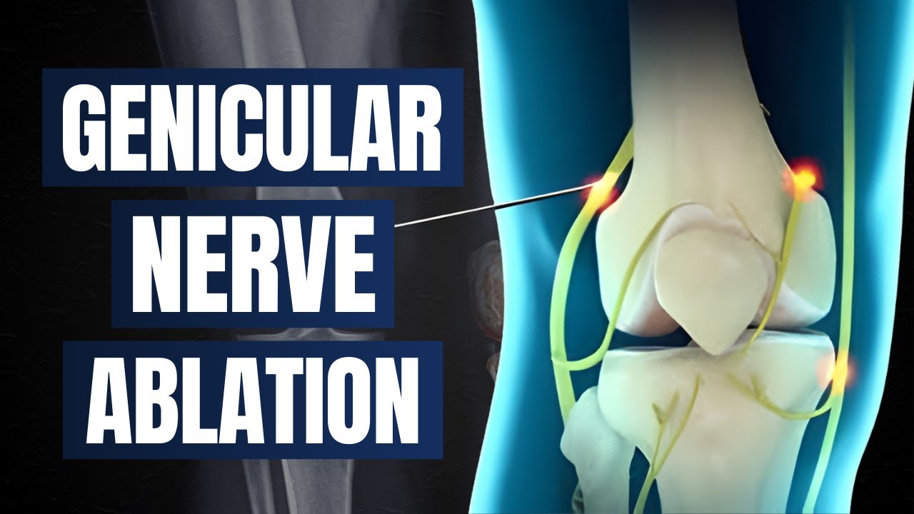 Genicular Injection Mmb Genicular Nerve Ablation: When Injections Aren't Enough - YouTube