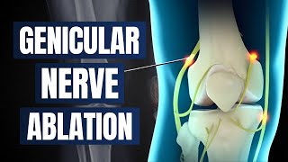 Genicular Nerve Ablation: When Injections Aren't Enough