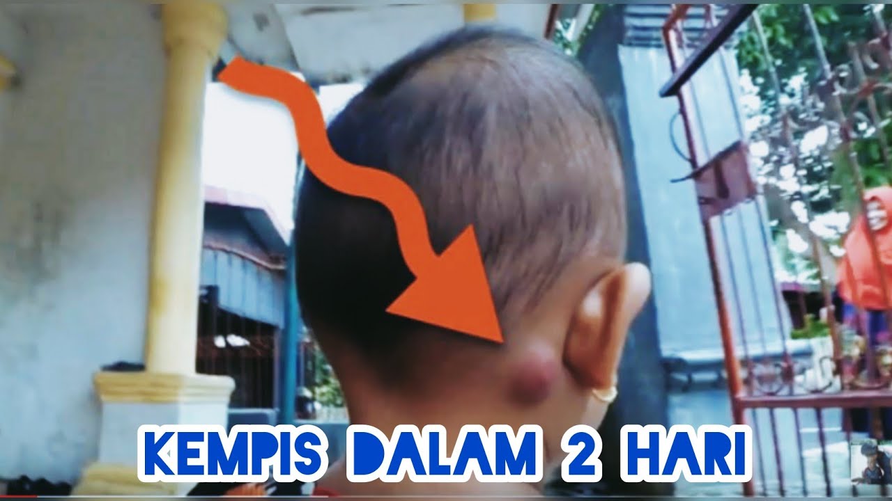Cara Alami Atasi Benjol Bisul Pada Anak 