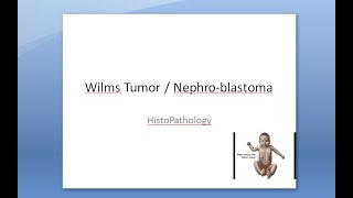 Pathology 700 a Wilms Tumor Kidney Nephroblastoma embryonal WAGR syndrome microscopy cancer child