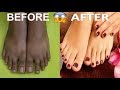 FEET WHITENING PEDICURE AT HOME - REMOVE SUN TAN & WHITEN YOUR FEET / Pooja Luthra