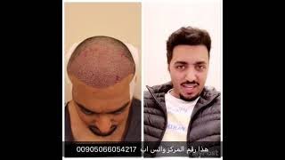 تكلفة زراعة الشعر في تركيا بالدولار 2022