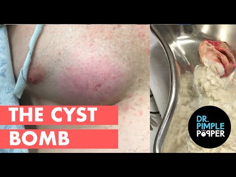 The Cyst Bomb - The Cyst Bomb