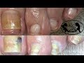 👣Pedicure Tutorial: How to Safely Cut Toenails Fungus Cure Update👣✔️