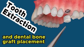 Tooth Extraction and Bone Grafting for Dental Implants