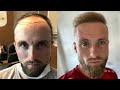 Hair Transplant Before and After - Month by Month Results | Elithair