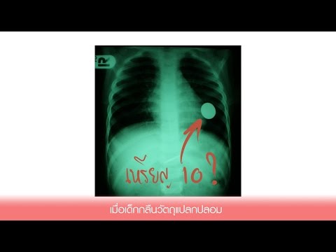 เรื่องดีๆมีไว้แชร์ : เมื่อเด็กกลืนวัตถุแปลกปลอม /ศูนย์กุมารเวช รพ.กรุงเทพพัทยา